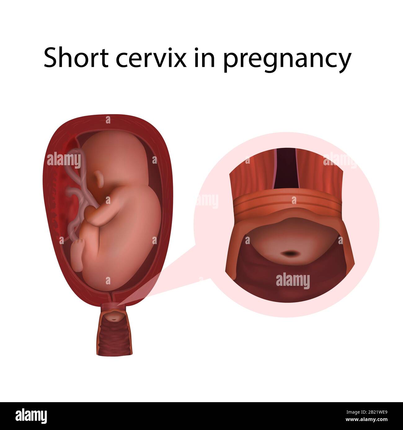 Breve cervice in gravidanza, illustrazione Foto Stock