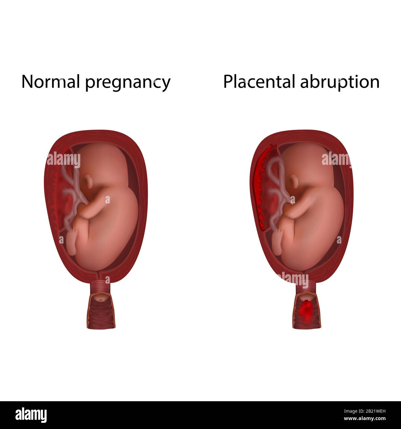 Distacco placentare e gravidanza sana, illustrazione Foto Stock