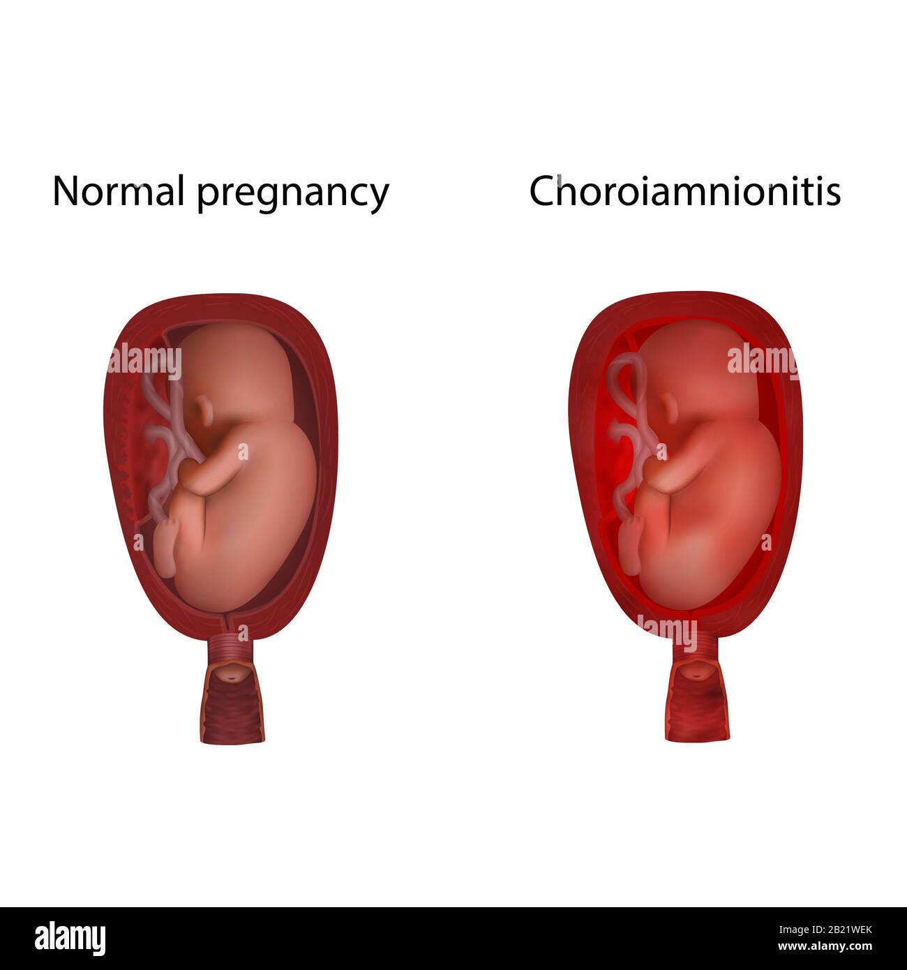 Coroiamnionite e gravidanza normale, illustrazione Foto Stock