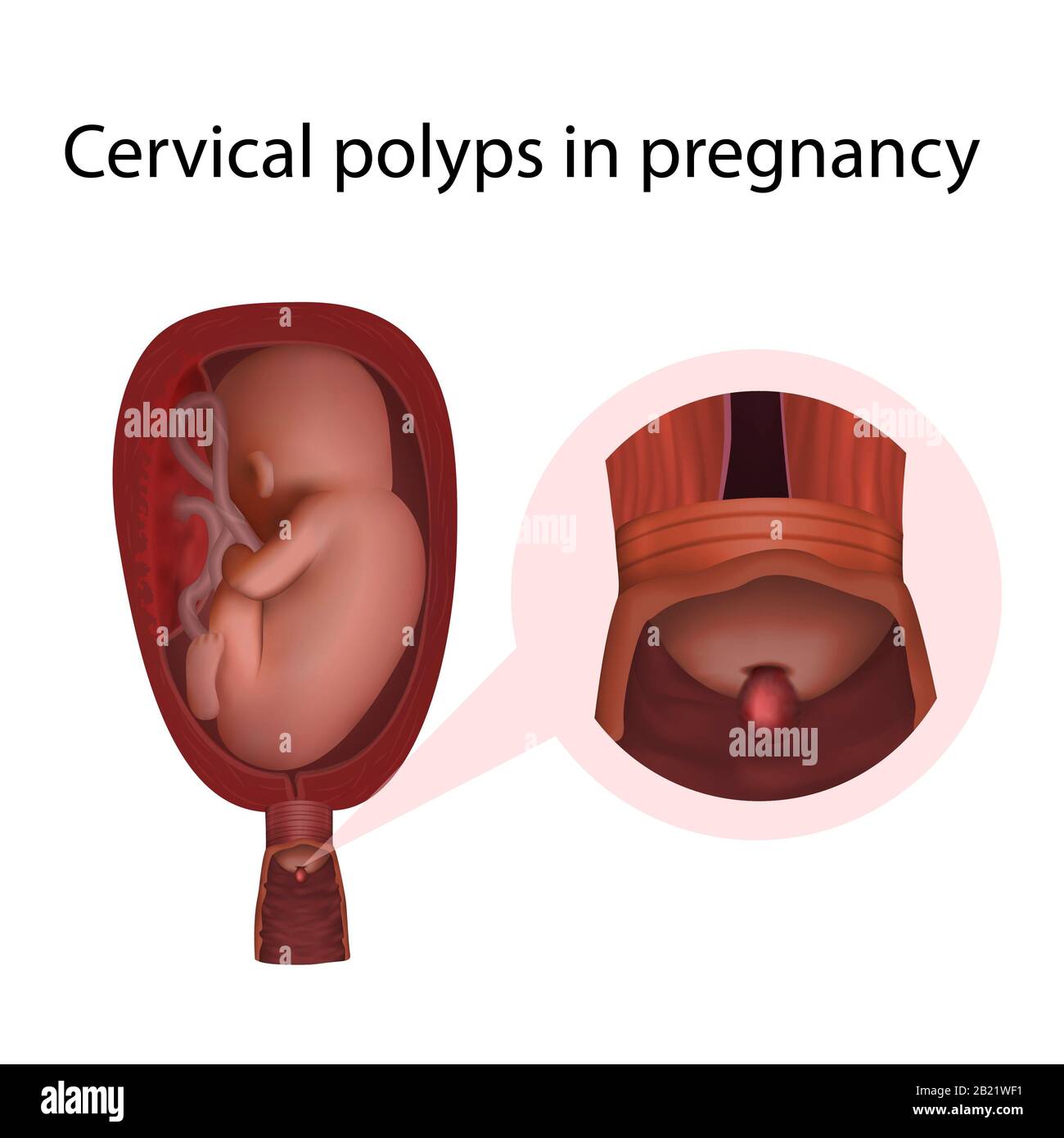 Polipi cervicali in gravidanza, illustrazione Foto Stock