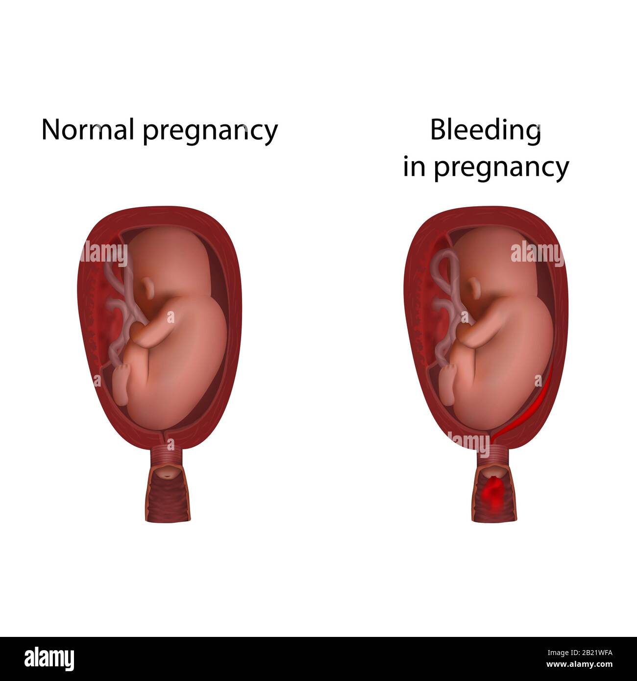 Sanguinamento in gravidanza, illustrazione Foto Stock