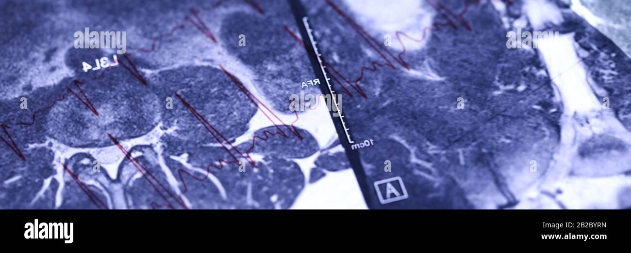 Immagine MRI situata sul grafico del cardiogramma Foto Stock