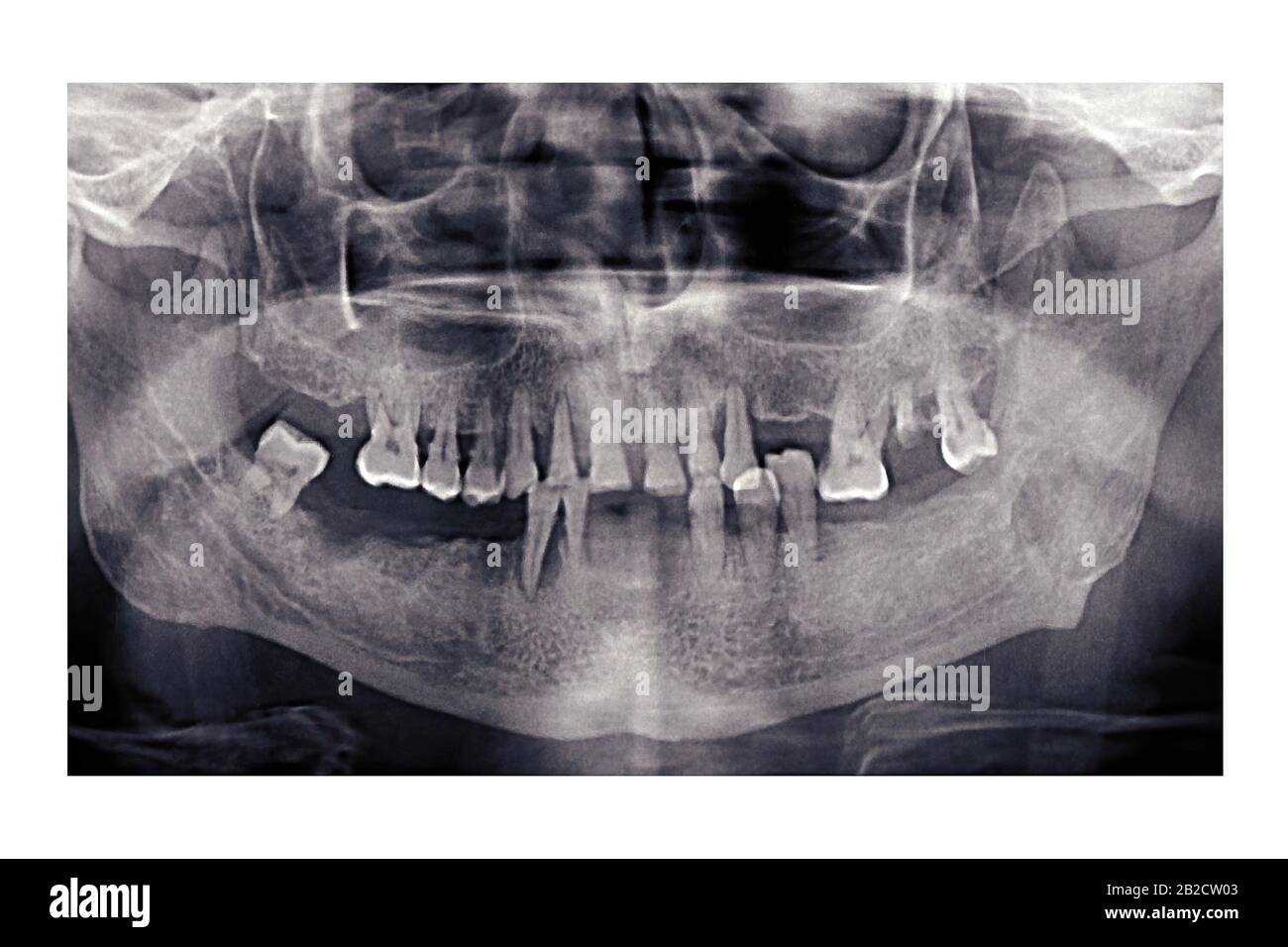 Raggi X dentali panoramici di una persona anziana. I denti difettosi sono caduti fuori. Istantanea della mascella del pensionato. Orthopantomogramma Foto Stock