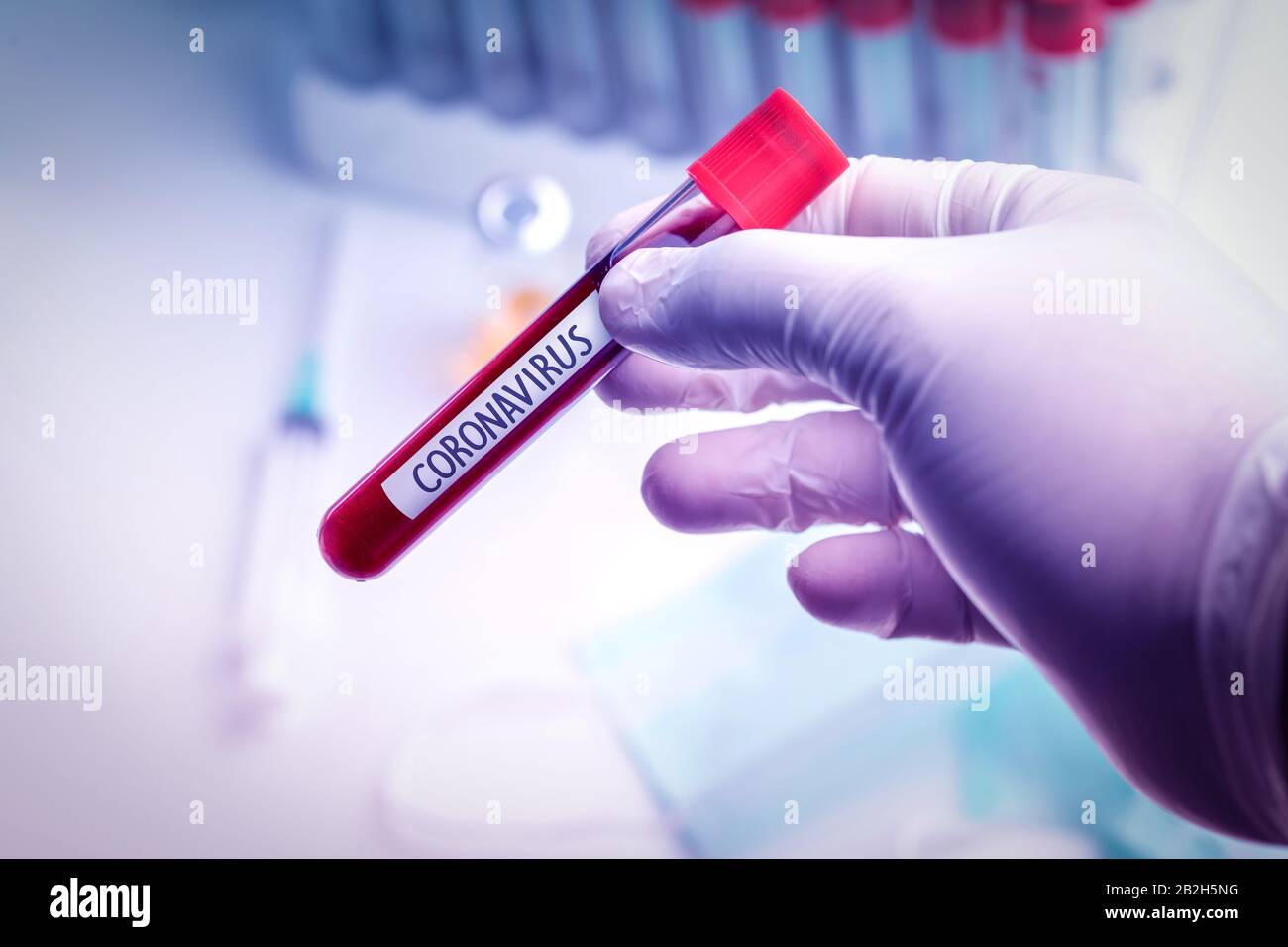Medico che indossa guanti medici che tengono una provetta per il sangue con campione di sangue positivo Coronavirus 2019-nCoV. Foto Stock