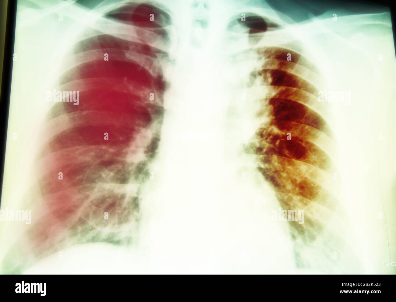 Petto di un esame a raggi x per la diagnosi La tubercolosi polmonare infezione con il polmone destro Foto Stock