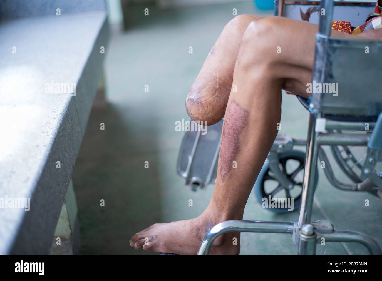 Al di sotto del ginocchio amputata paziente seduto su una sedia a rotelle, BK dispositivo preparato, il moncone di bendaggio e la forza della gamba Foto Stock