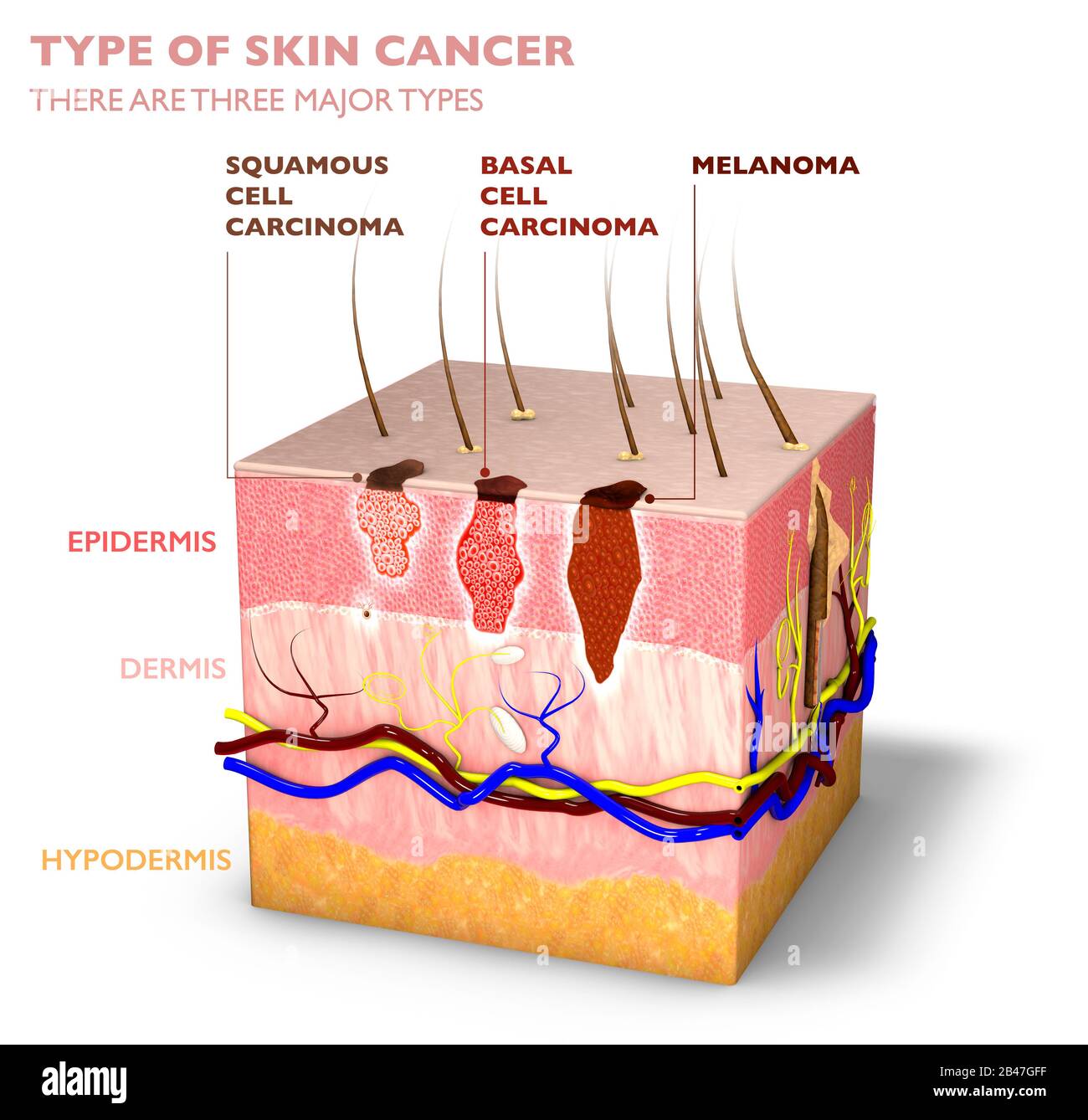 Tumori cutanei, moli e macchie, sezione 3d dello strato cutaneo. Tre tipi di cancro della pelle, carcinoma a cellule squamose, carcinoma a cellule basali, melanoma Foto Stock