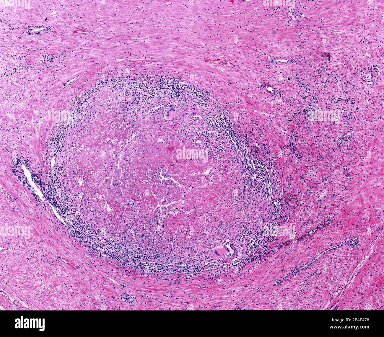 Tuberculosis granuloma con necrosi centrale (necrosi casea), infiltrato linfocitico e cellula di Langhans multinucleata. Foto Stock