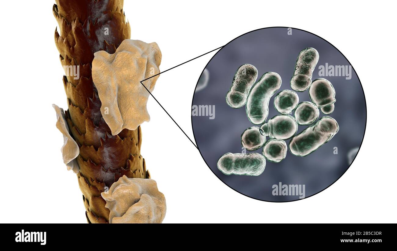 Capelli umani con forfora, illustrazione Foto Stock