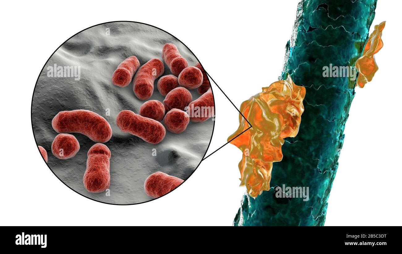 Capelli umani con forfora, illustrazione Foto Stock