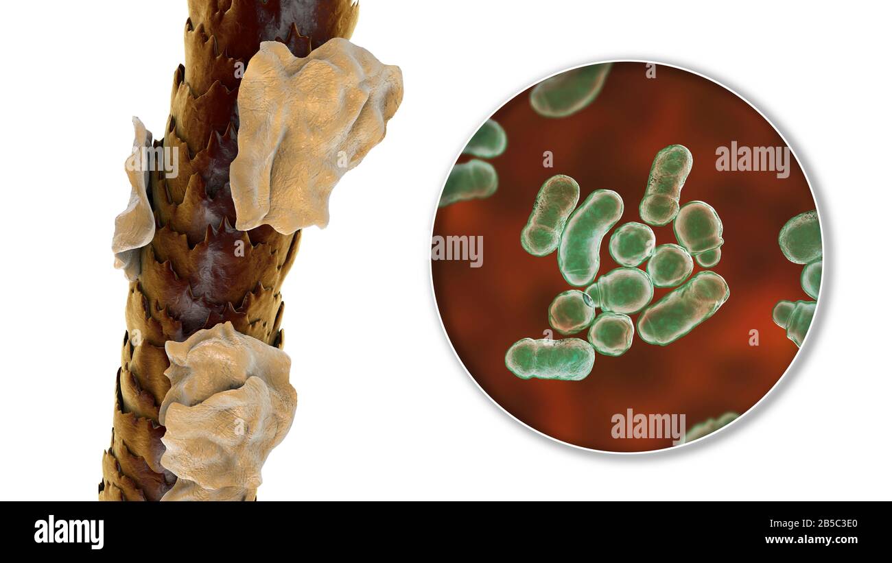 Capelli umani con forfora, illustrazione Foto Stock