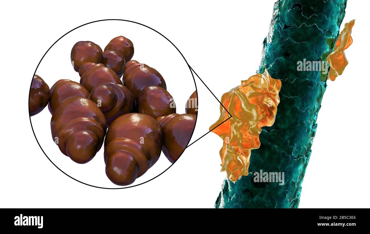 Capelli umani con forfora, illustrazione Foto Stock