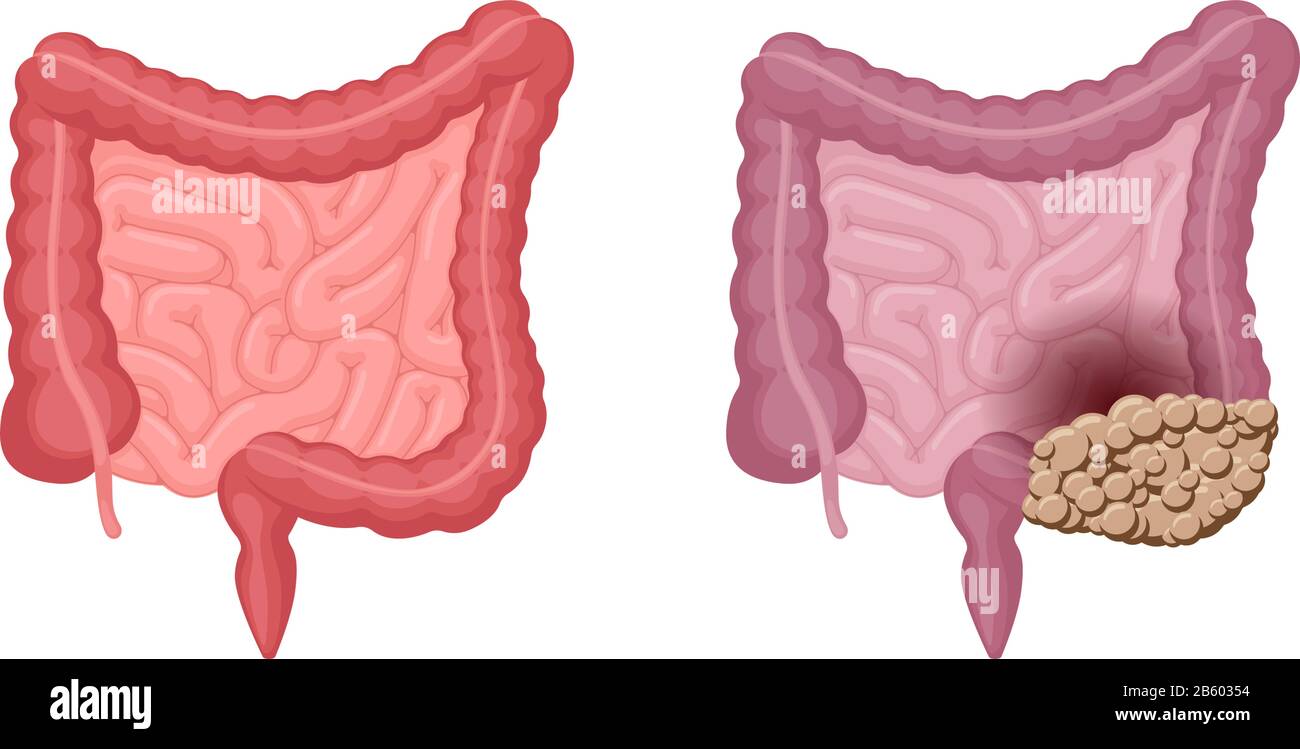 Anatomia intestinale umano forte sano e malsano con il confronto del cancro del colon. Cavità addominale tumore oncologico dell'organo interno escreto e digestivo. Illustrazione eps problema di digestione vettoriale Illustrazione Vettoriale