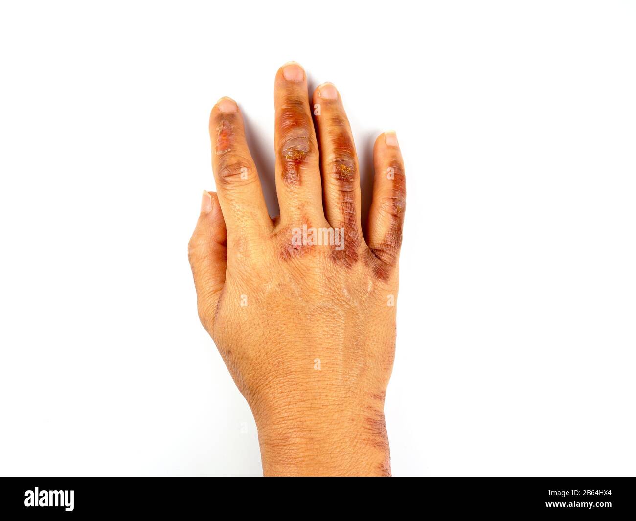 Mano di una donna di mezza età bruciata su sfondo bianco isolato, Orribili  ustioni sulla mano femminile Foto stock - Alamy