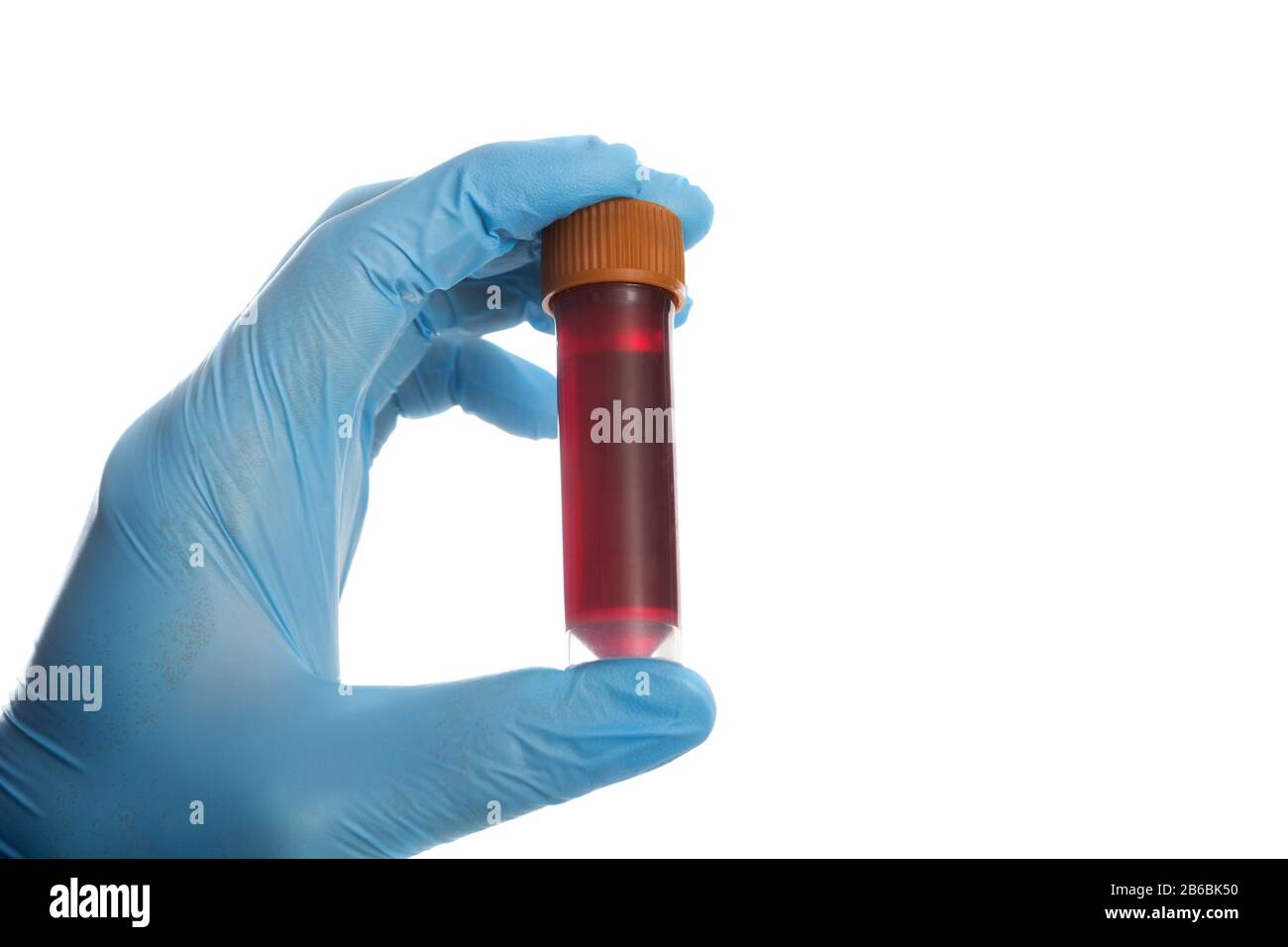 Provetta per analisi del sangue in una mano medica con guanti medici blu. Foto Stock