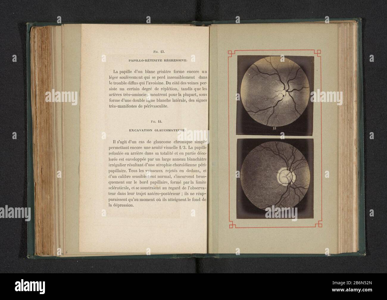 Fotoreproductie van twee anatomische tekeningen van een regresseve ontsteking van een optische schijf en vervorming van een oog door glaucoom riproduzione di due disegni anatomici di un'accensione regressiva di un disco ottico, e distorsione di un occhio con glaucoma tipo di oggetto: Riproduzione fotografica numero Di pagina: RP-F-2001-7-167-7 Iscrizioni / marchi: Iscrizione, recto , stampato: 'La Fig. 13. Rétinite Papillo-Regressivo. Fig. 14. Glaucomateuse di scavo.' Produttore : fotografo: Anonimamente al disegno di: Anonymous date: CA. 1871 - in o davanti 1881 Materiale: Carta fotografica te Foto Stock