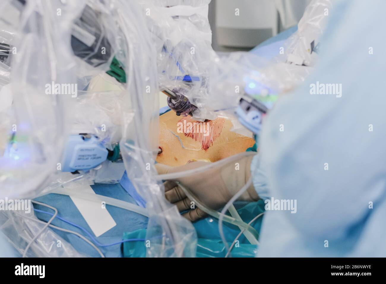 Il processo di esecuzione di un intervento chirurgico utilizzando un moderno sistema chirurgico robotico. Robot medico. Chirurgia robotica minimamente invasiva. Foto Stock