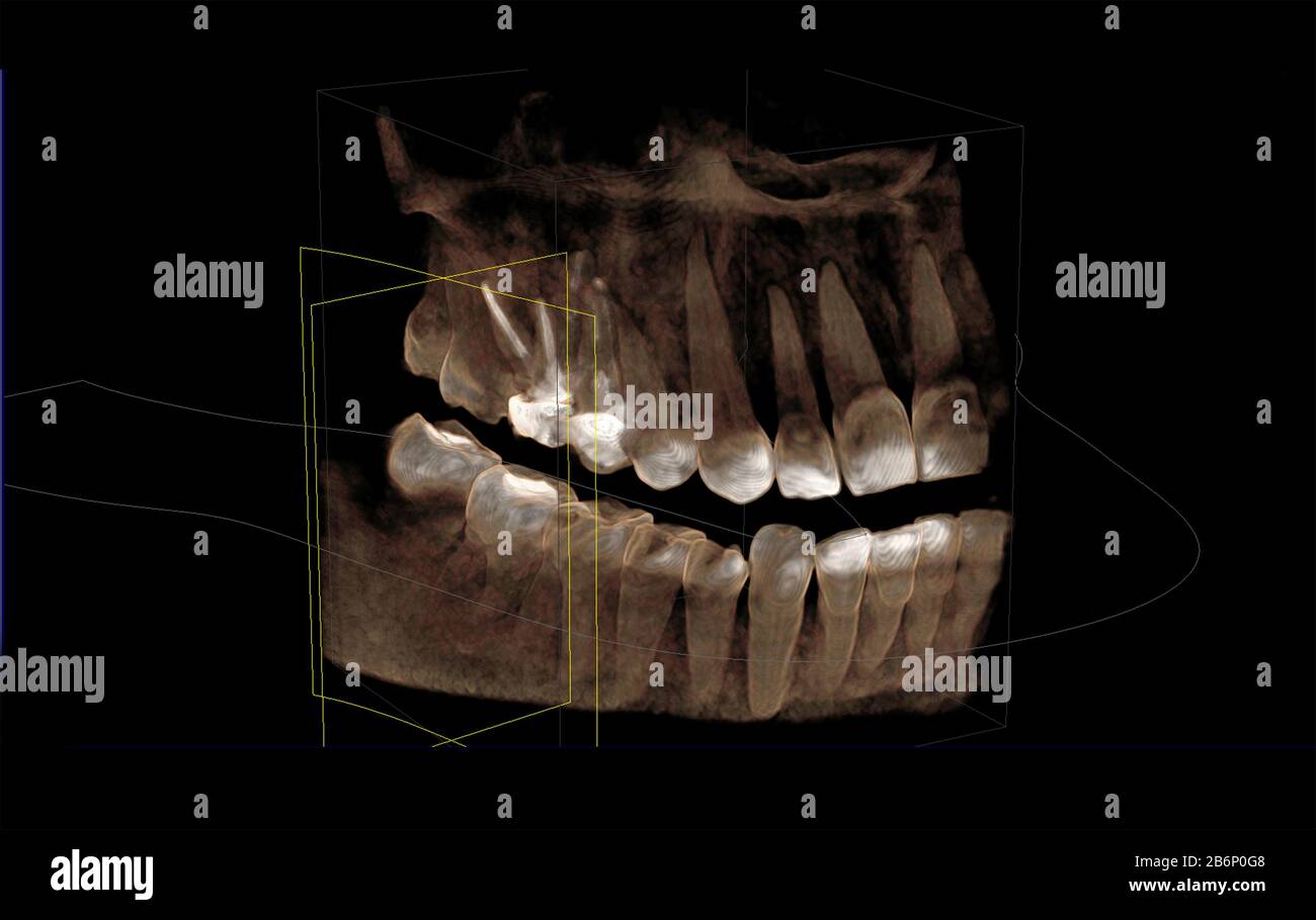 Visualizzazione in 3D di un tomogramma informatico della dentizione Foto Stock