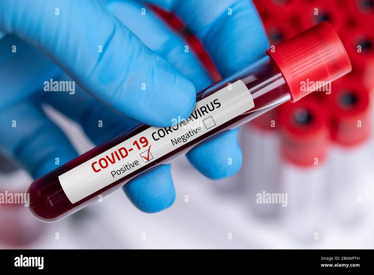 Campione Di Sangue Di Coronavirus 2019-Ncov. Il virus Corona è in uscita. Virus Epidemico Sindrome Respiratoria. Foto Stock
