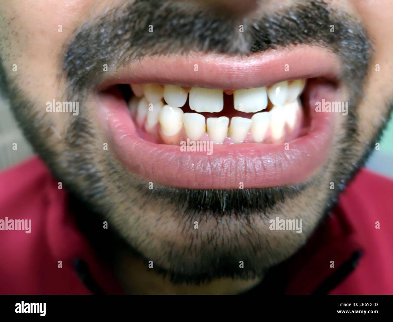 Un uomo con la barba mostra i denti, ha un'apertura dei denti. Foto Stock