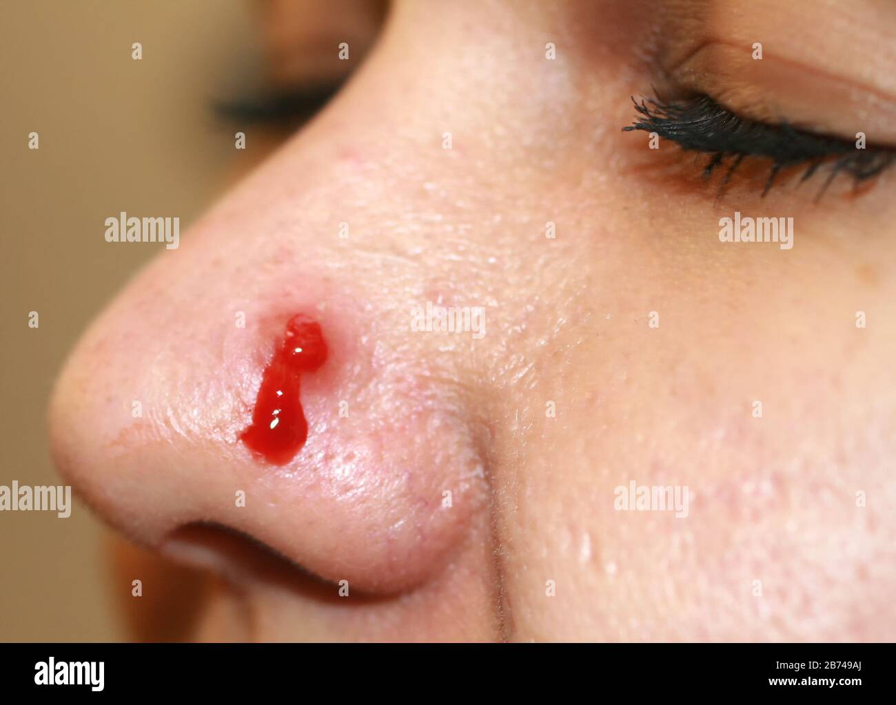 Pimple infiammato sul naso. Cisti acne. Acne sulla pelle Foto stock - Alamy