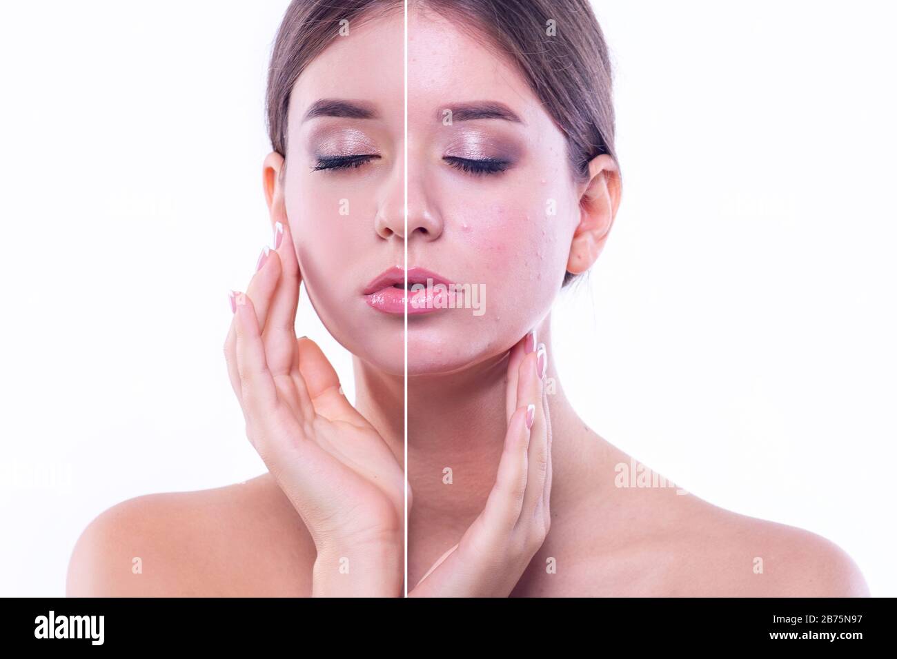 Effetto di guarigione della pelle, acne trattamento, bellezza giovane donna prima e dopo la procedura su uno sfondo bianco. Foto Stock