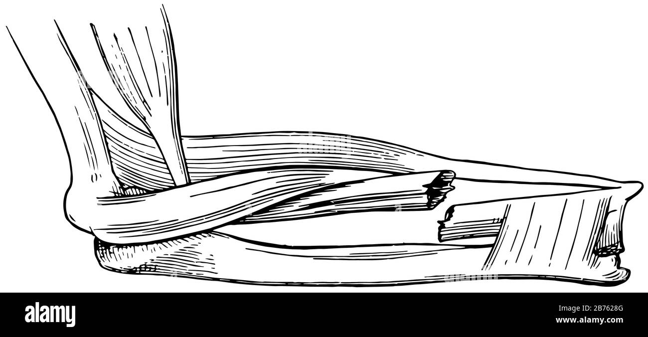 Quando un osso è rotto, il sangue fuoriesce tra le parti ferite, il disegno di linea vintage o l'illustrazione dell'incisione. Illustrazione Vettoriale