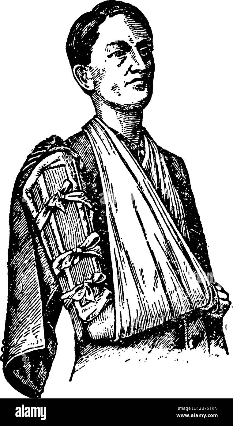 Due schegge applicate, una davanti, l'altra dietro, se la parte inferiore dell'osso è rotta; o ai lati interno ed esterno, disegno di linea vintage o. Illustrazione Vettoriale