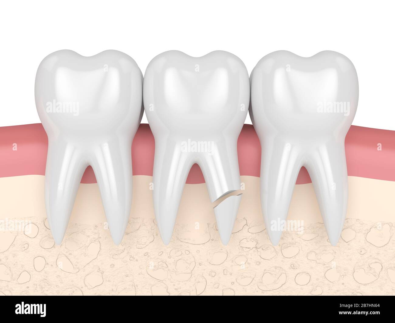 rendering 3d delle gengive con radice dentaria incrinata su sfondo bianco. Diversi tipi di denti rotti concetto. Foto Stock