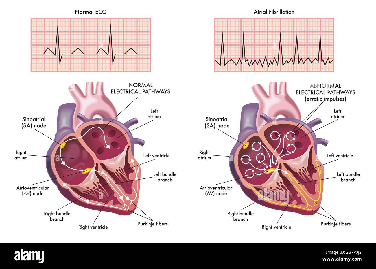 Illustrazione medica che mostra i sintomi di un cuore con fibrillazione atriale rispetto a quello normale. Foto Stock