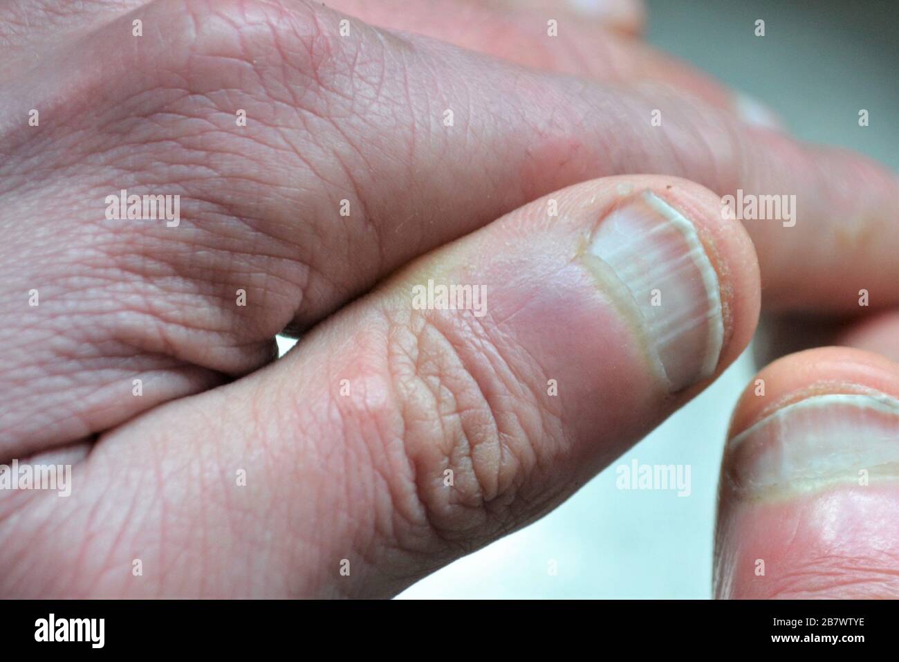 Primo piano di un paio di mani, mostrando chiodi pollice con creste verticali, un segno di invecchiamento o problemi medici sottostanti o condizioni Foto Stock