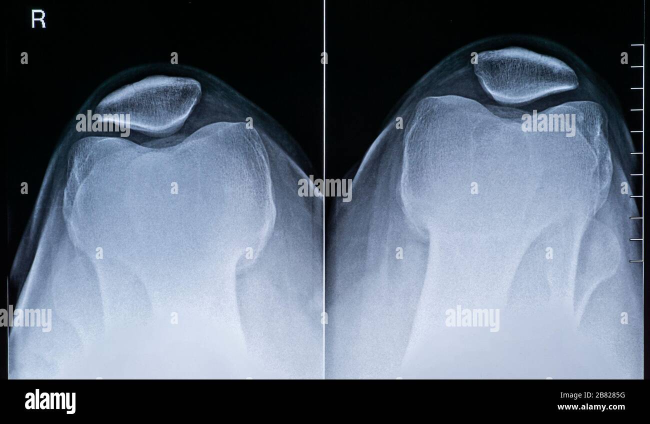Immagine a raggi X vista dall'alto anatomia ginocchio destro maschile adulto umano. Radiografia e immagini mediche. Foto Stock
