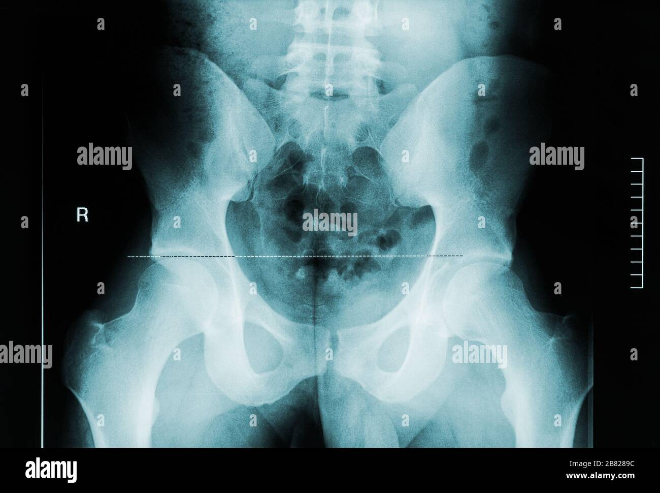 Vista posteriore immagine radiografica del bacino maschile, del collo femorale e delle vertebre lombari. Immagini anatomiche mediche e umane. Foto Stock
