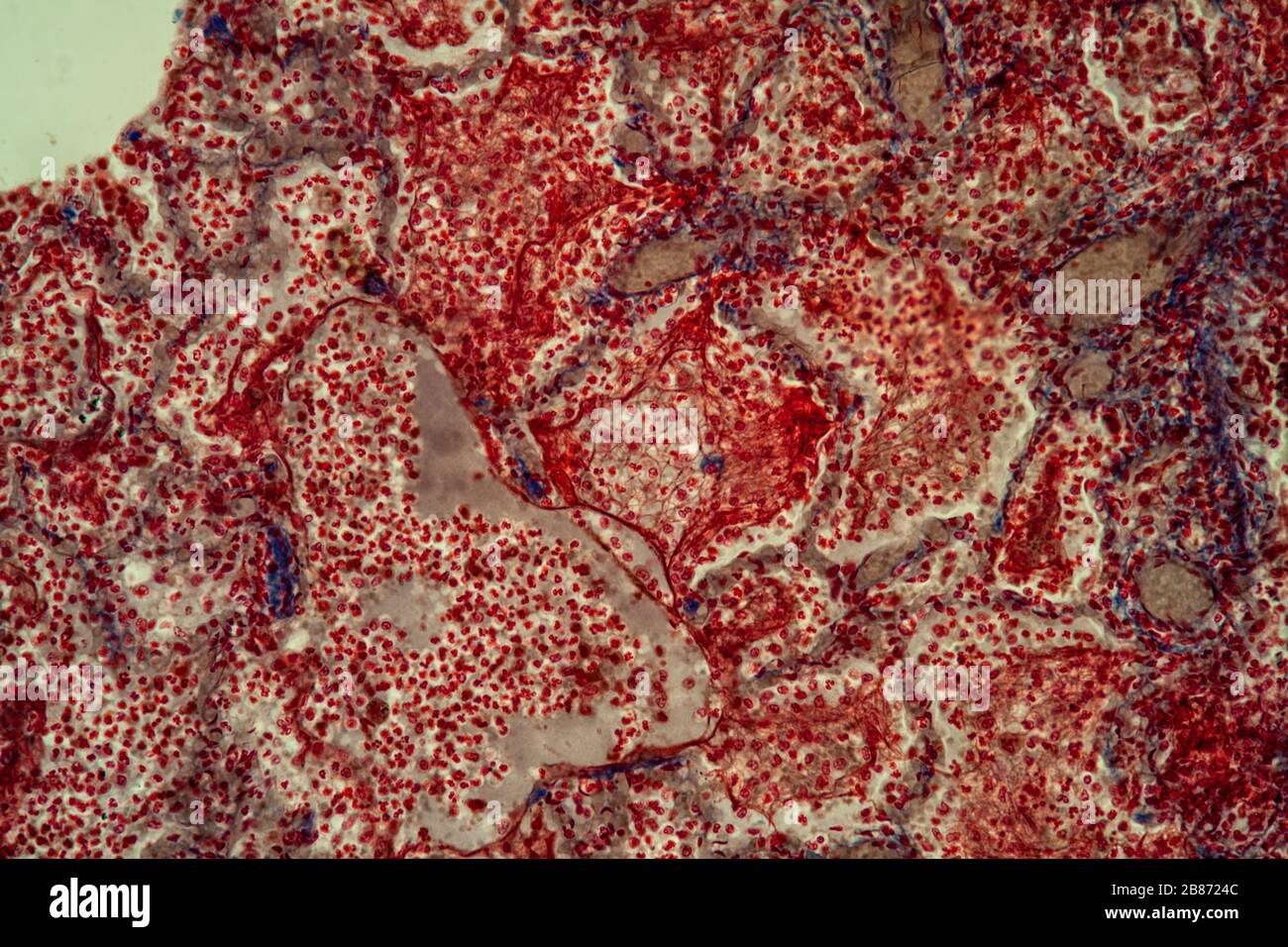 La tubercolosi polmonare tessuti sotto il microscopio 200x Foto Stock