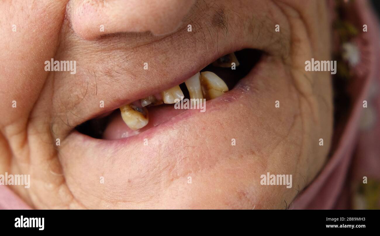 donna anziana senza denti, donna anziana con pochi denti in bocca, Foto Stock