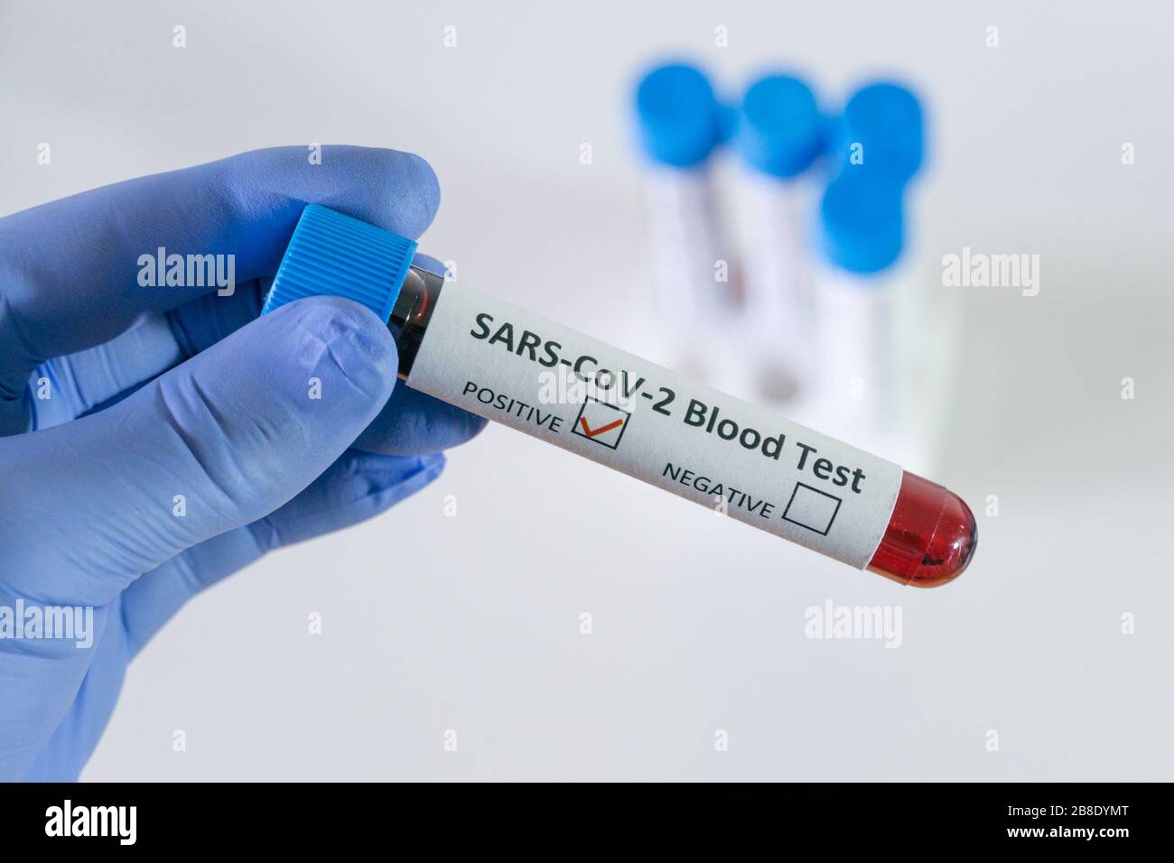 Risultato positivo del test del sangue per SARS COV 2, coronavirus che causa la malattia di Covid 19 Foto Stock