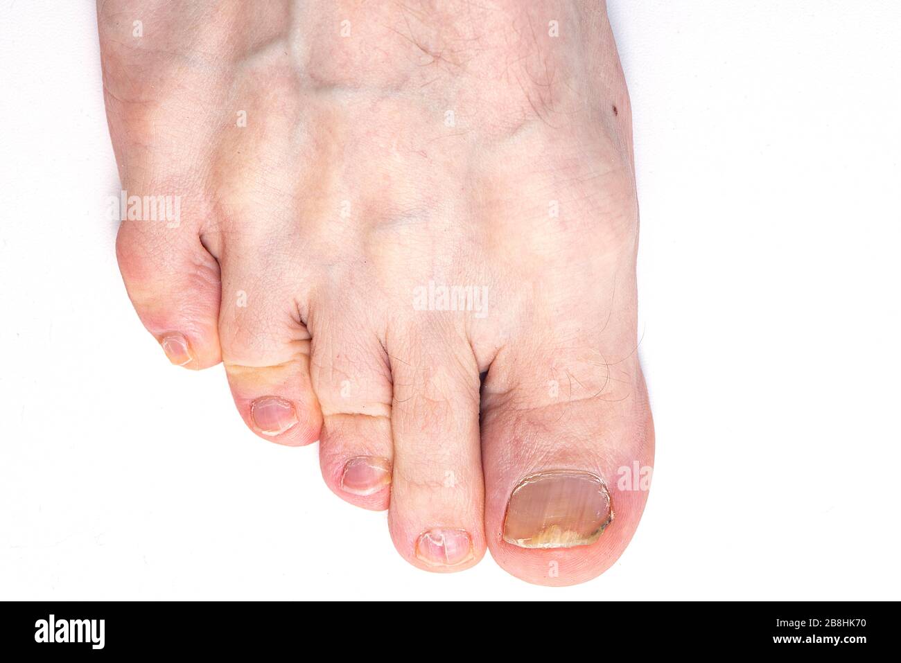 Primo piano toenail Fungus isolato su sfondo bianco, Nail Fungus sulle gambe dell'uomo Foto Stock