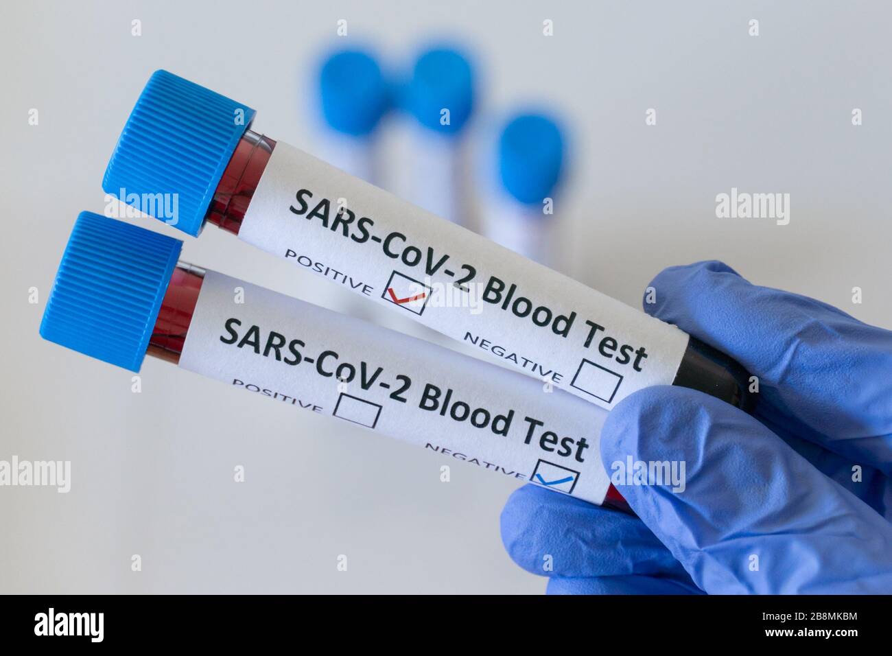 Risultato positivo del test del sangue per SARS COV 2, coronavirus che causa la malattia di Covid 19 Foto Stock