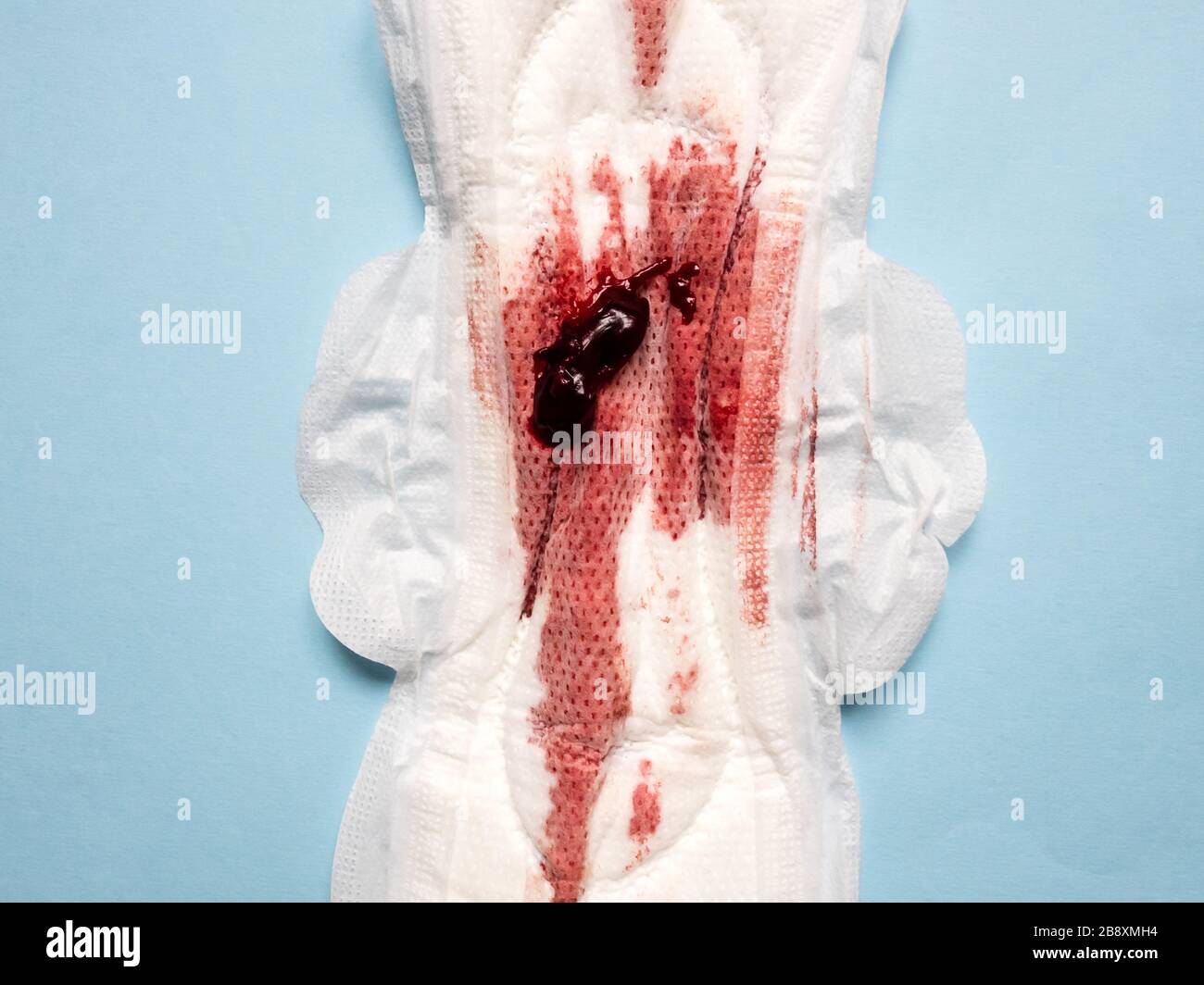 Sintomo di endometriosi, sangue mestruale con coaguli di sangue su un cuscinetto sanitario, immagine ravvicinata Foto Stock