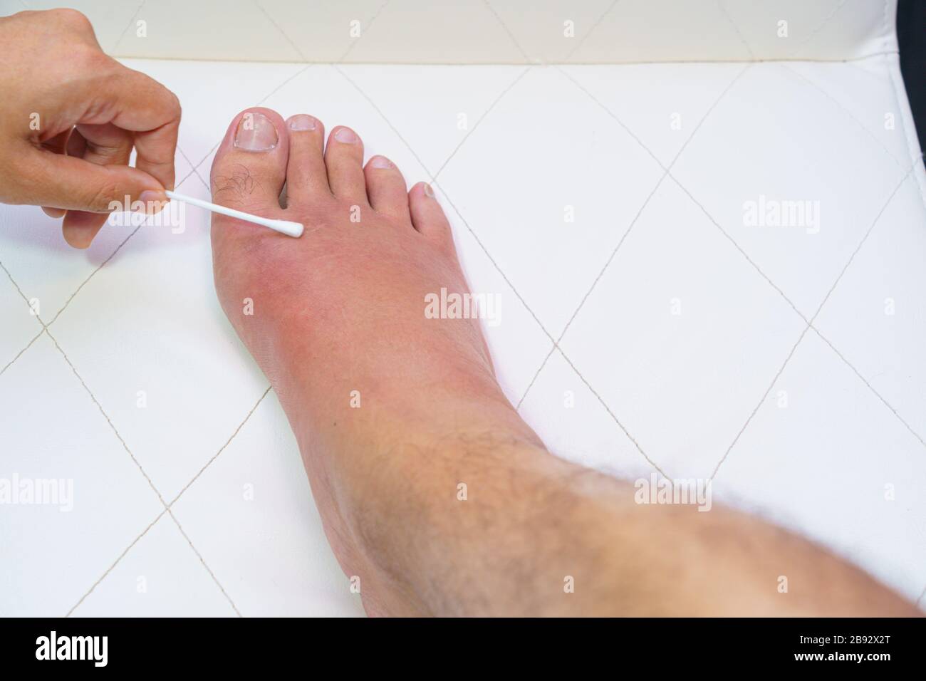 Primo piano vecchio piede destro, caviglia ferito in attesa e gonfiore malattia infettiva da apicoltura reazioni allergiche trattamento infermieristico sulla medicazione a ferita Foto Stock