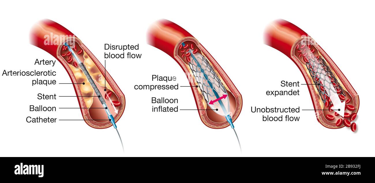 Illustrazione medica che mostra l'angioplastica con palloncino e l'inserimento dello stent Foto Stock