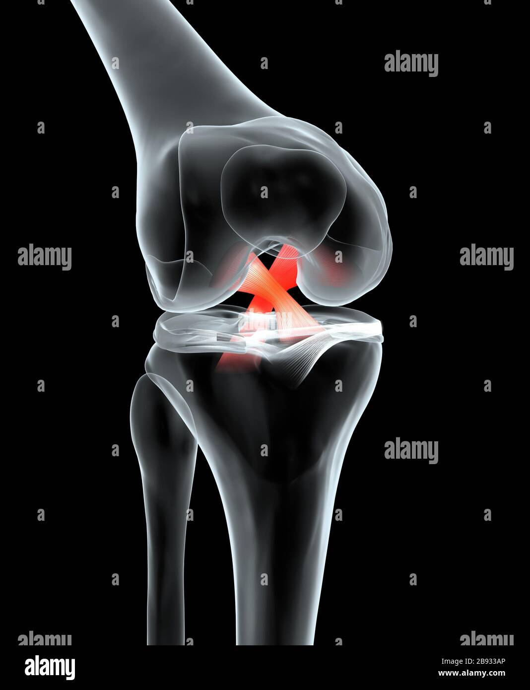 Dal punto di vista medico accurato 3D illustrazione che mostra la dolorosa del ginocchio con evidenziati anteriore e legamento crociato posteriore, menisco, la cartilagine articolare Foto Stock