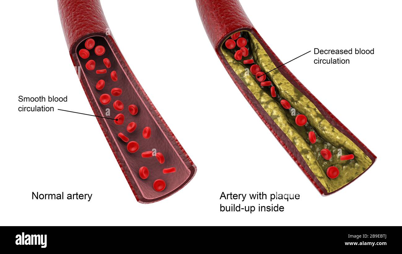 Confronto tra un'arteria sana e un'arteria malsana con l'accumulo di placca all'interno. Foto Stock