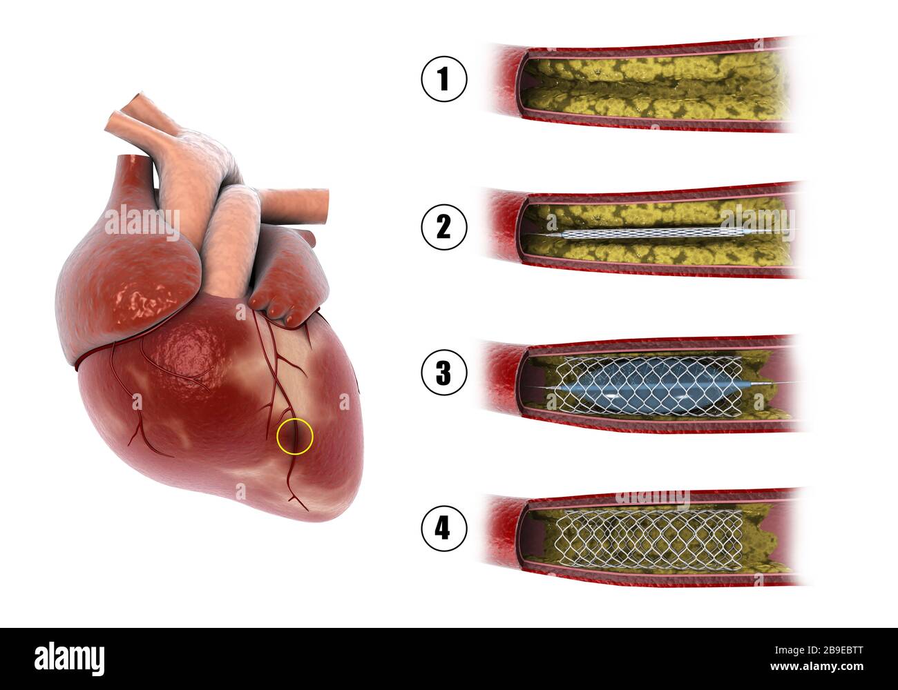 Diagramma che mostra la procedura di angioplastica con palloncino per ampliare le arterie ostruite nel cuore. Foto Stock