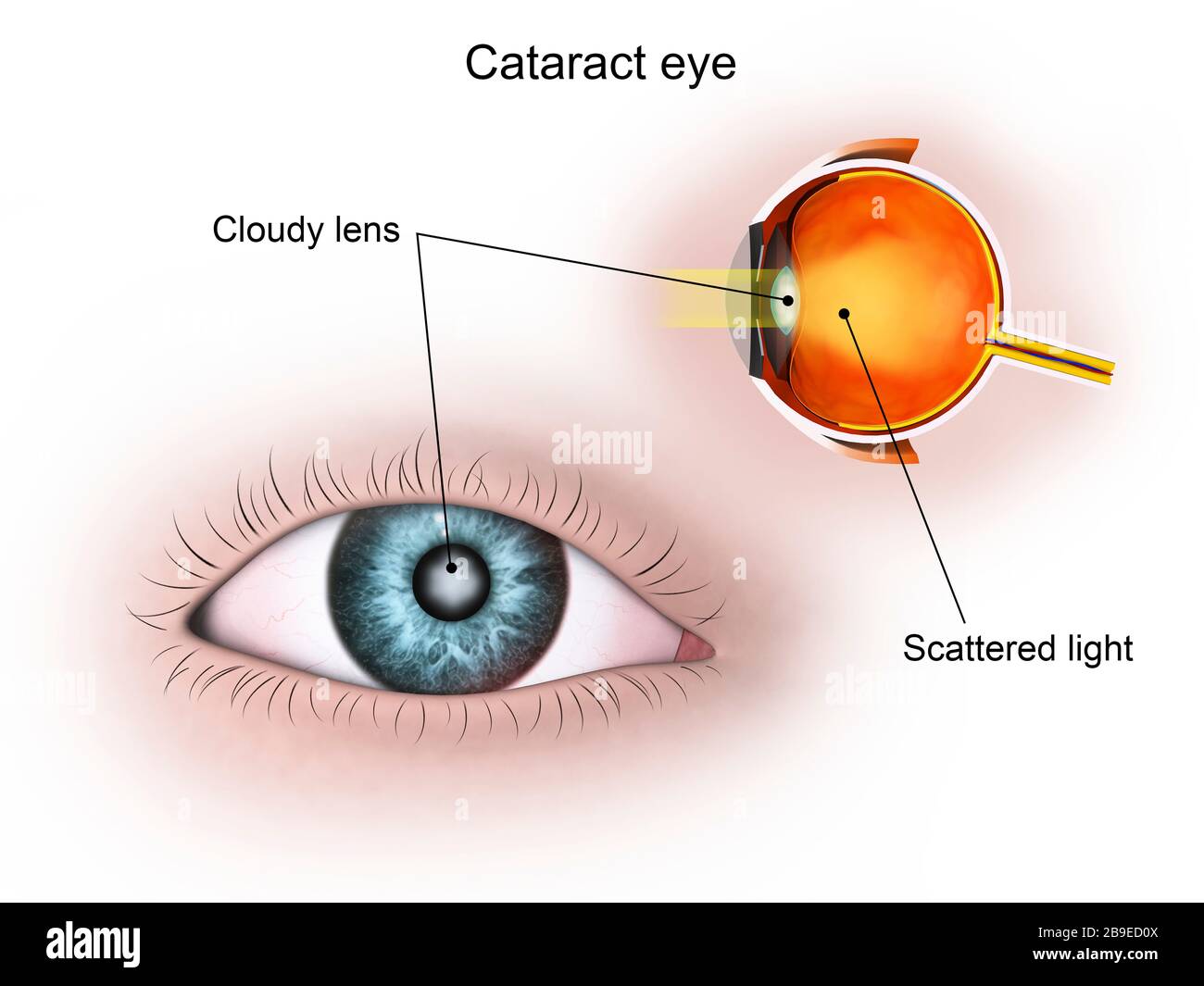 Illustrazione medica di una cataratta nell'occhio umano. Foto Stock