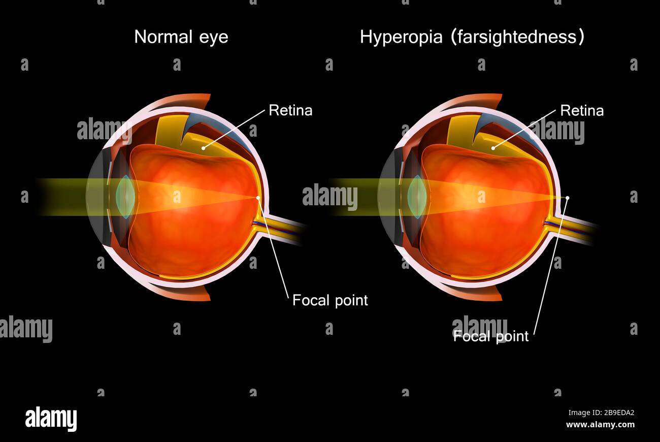 Confronto tra un occhio normale e un occhio con iperopia. Foto Stock