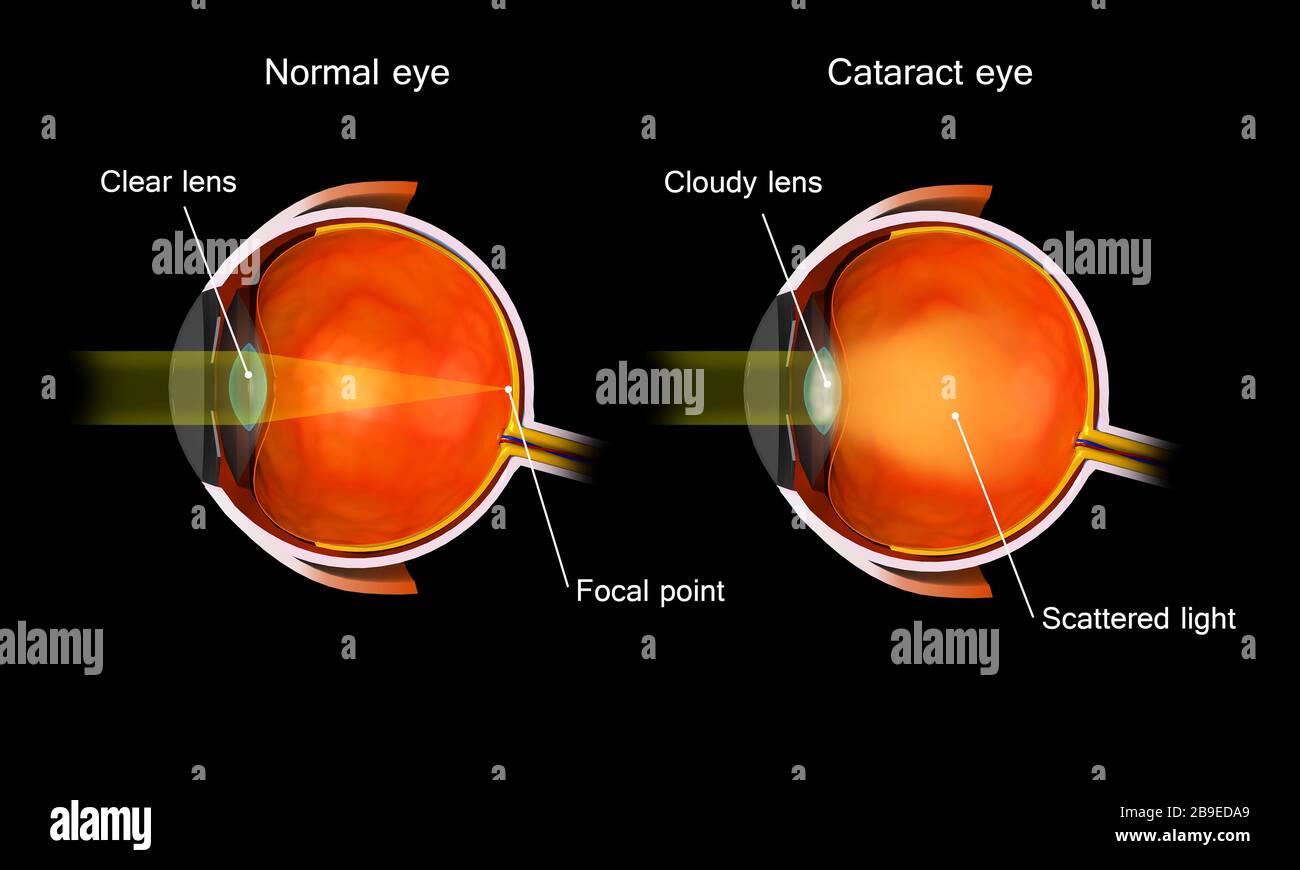 Illustrazione medica di una cataratta nell'occhio umano, rispetto ad un occhio normale. Foto Stock