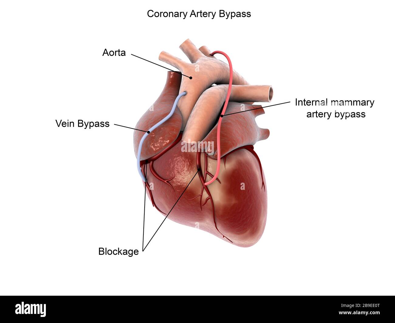 Bypass dell'arteria coronaria del cuore umano. Foto Stock