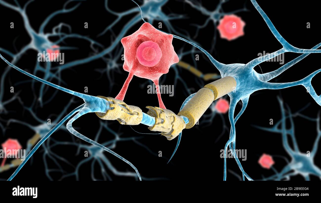 Immagine concettuale di un neurone di sclerosi multipla guarito da una cellula T. Foto Stock