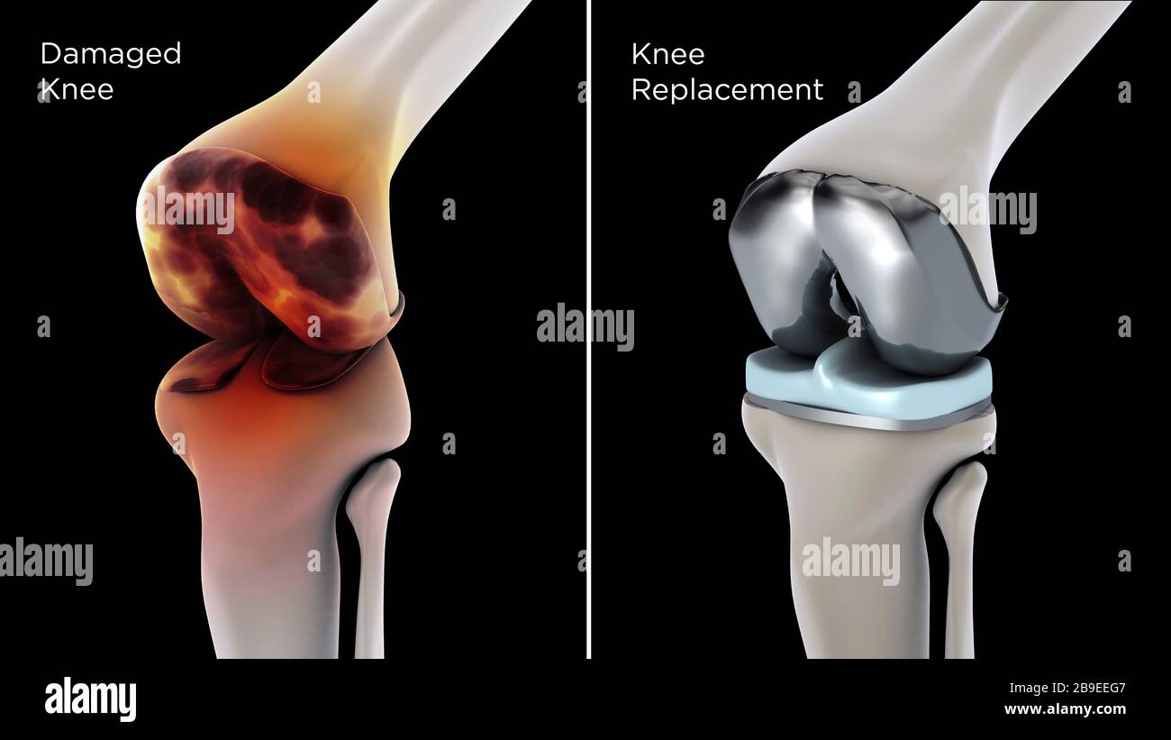 Illustrazione medica che mostra la sostituzione del ginocchio danneggiato. Foto Stock